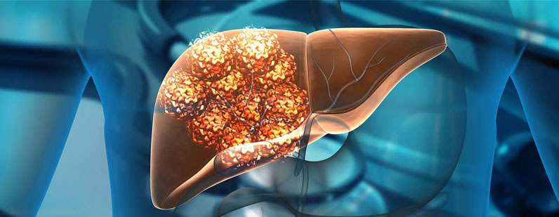 Liver Transplantation in Colorectal Metastases