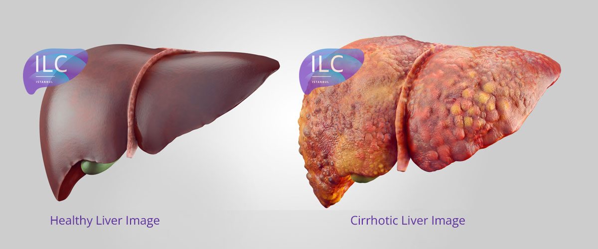 Liver Cirrhosis Liver Cirrhosis