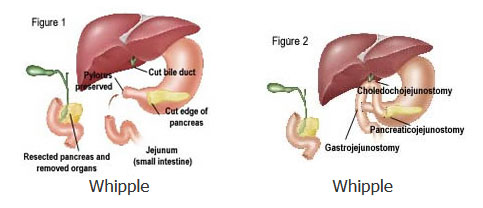Pancreatic Surgery