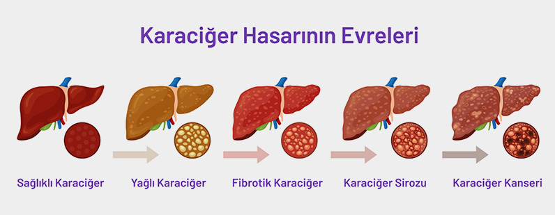 Karaciğer Tümörlerinin Ameliyatları: Tam Rehber